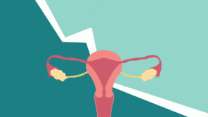 Endometriose